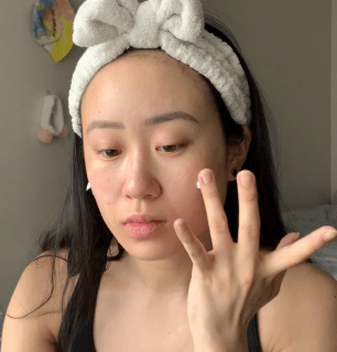 real patient social post instagram @skin_tings